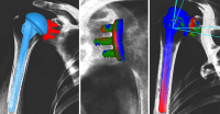 PHẪU THUẬT CHỈNH HÌNH KHỚP VAI  VỚI PHẦN MÊM mediCAD® Shoulder 3D (Phần 1)