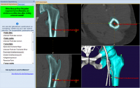 SỬ DỤNG PHẦN MỀM MediCAD ® 3D Hip TRONG PHẪU THUẬT KHỚP HÁNG, XƯƠNG HÔNG, XƯƠNG ĐÙI (Phần 3)