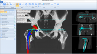 SỬ DỤNG PHẦN MỀM MediCAD ® 3D Hip TRONG PHẪU THUẬT CHỈNH HÌNH (Phần 2)